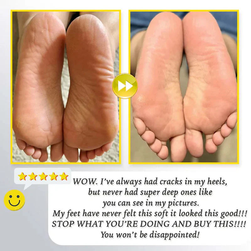 Uppladdningsbar Elektrisk Fotfil för Förhårdnader